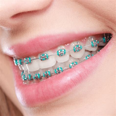 bracket metal mini orthodontic|different types of metal brackets.